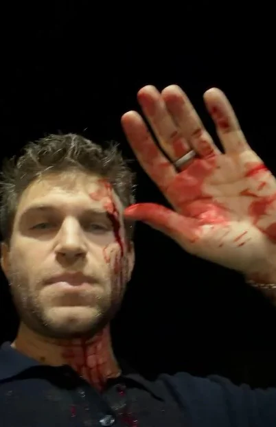 Keegan Allen's screen grab from his instagram post, showing him bloodied after an attack